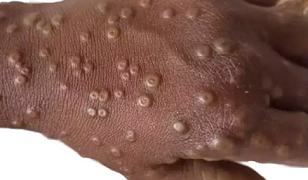 Is India at risk after WHO's Mpox alert ?